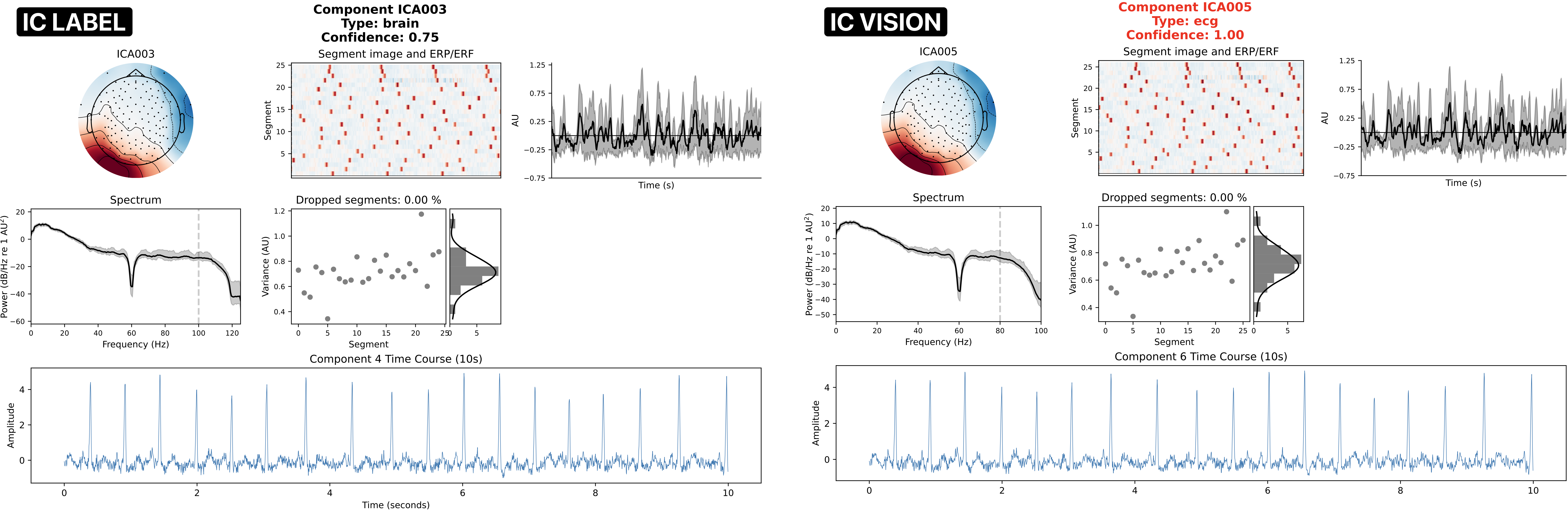 Side-by-side comparison showing ICLabel incorrectly classifying a cardiac artifact as brain activity (left) while ICVision correctly identifies it as a heart artifact (right)