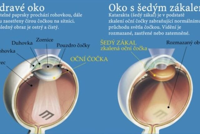 šedý zákal