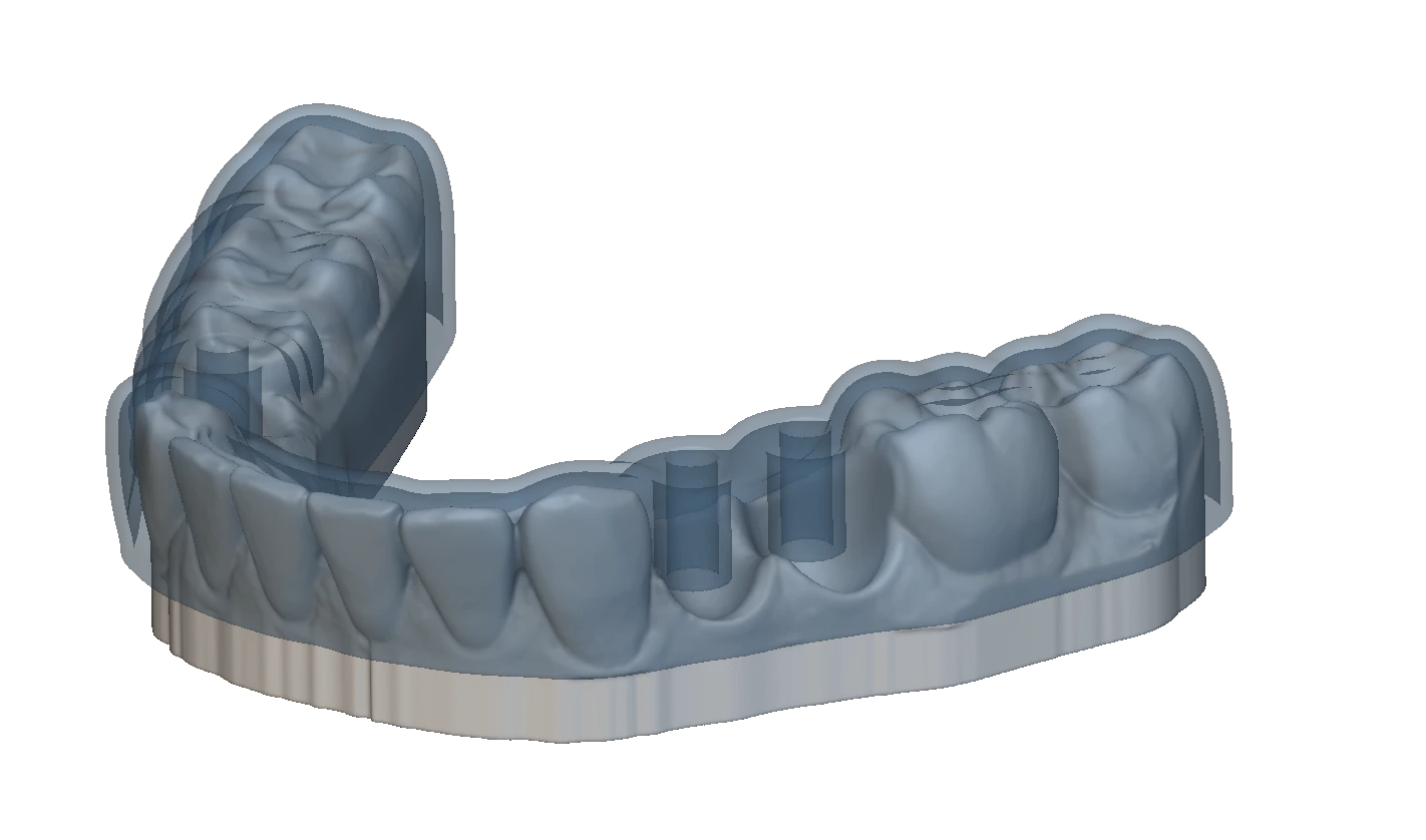 Dental Splints and Surgical Stents