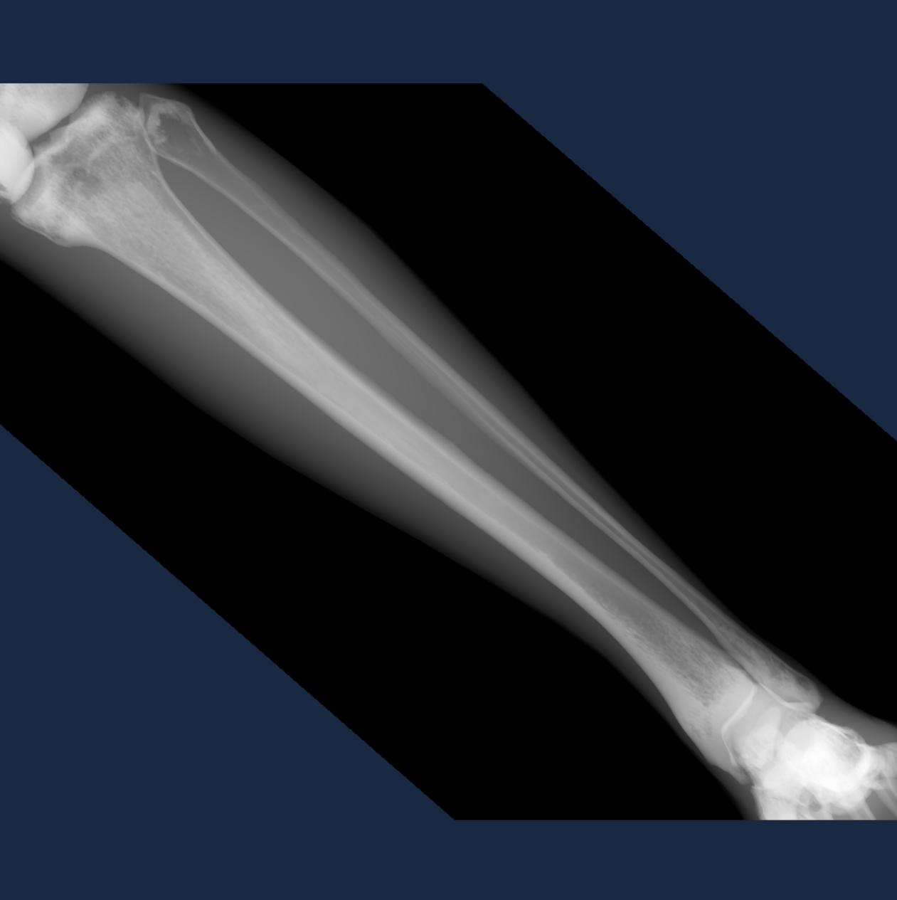 Example exposure from the Tibia and Fibula simulation